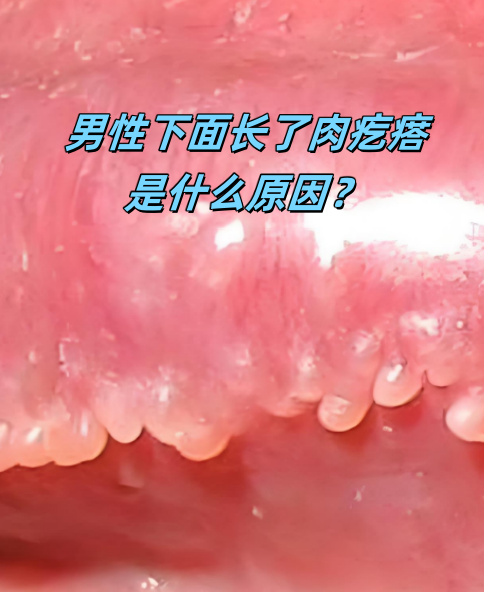 男生器官上长了疣是因为什么