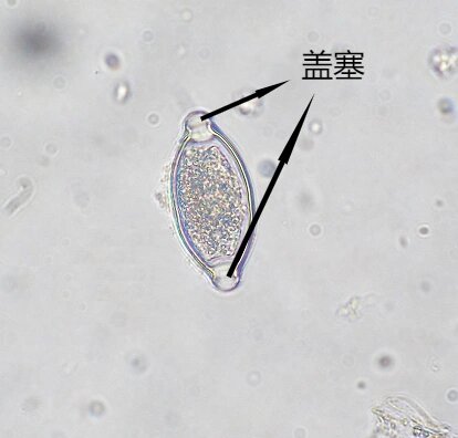 高清肝包虫图片 虫卵图片