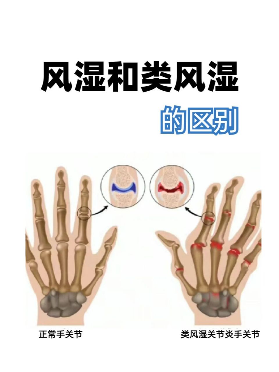 风湿和类风湿有哪些区别呢?