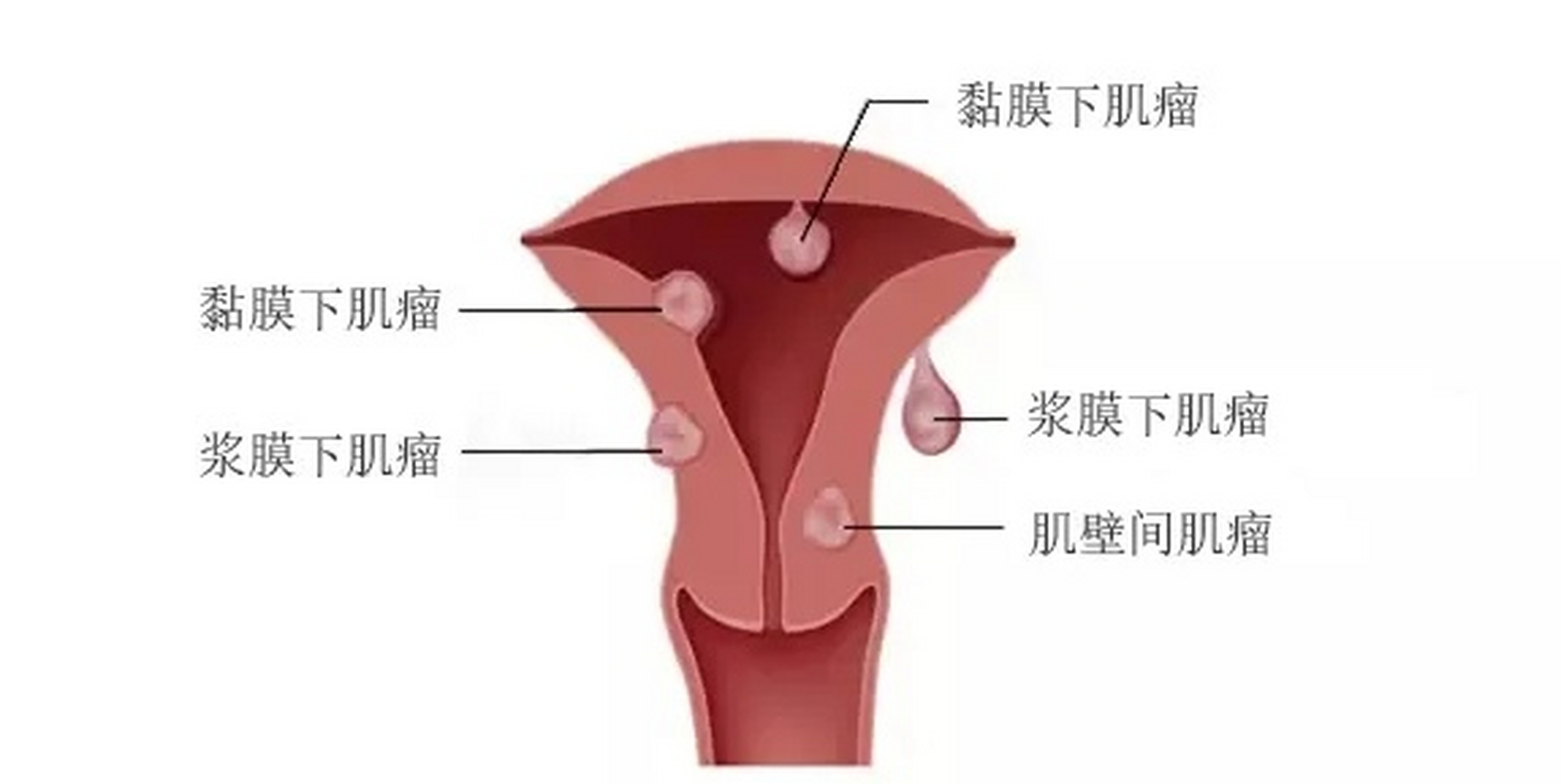 【这一类女性更易长子宫肌瘤】子宫肌瘤多见于30~50岁女性,41~50岁尤