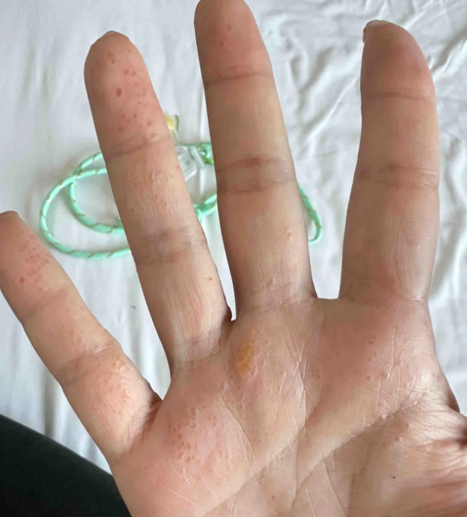 手起水泡很痒的时候,可以试试这些方法: