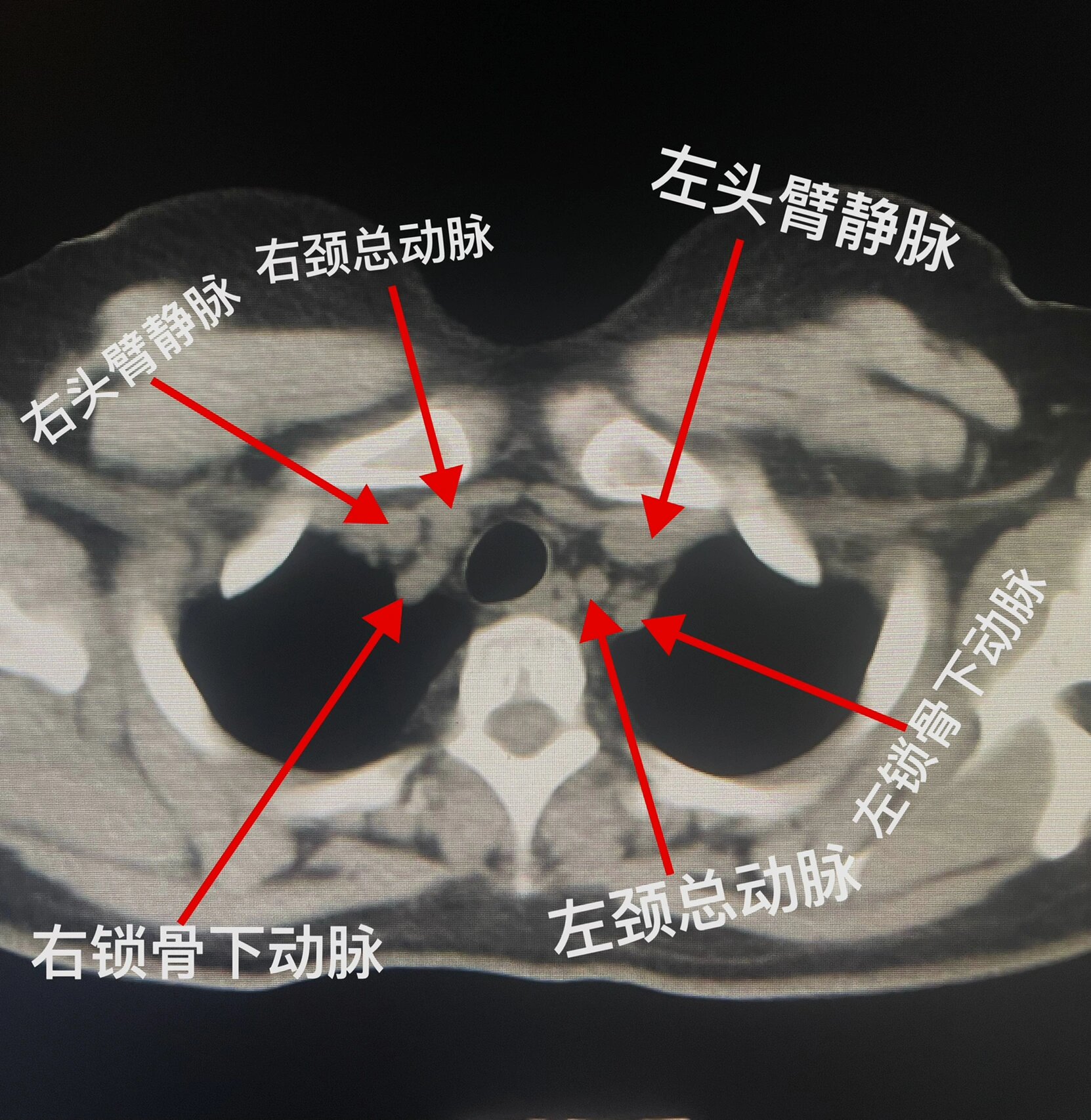 纵隔窗ct图图片