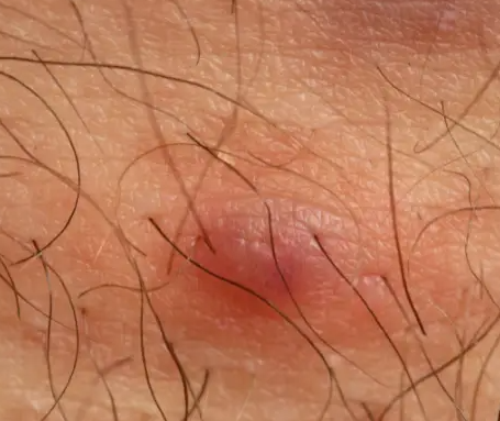 外阴长疙瘩常见的原因有外阴毛囊炎,外阴炎或尖锐湿疣