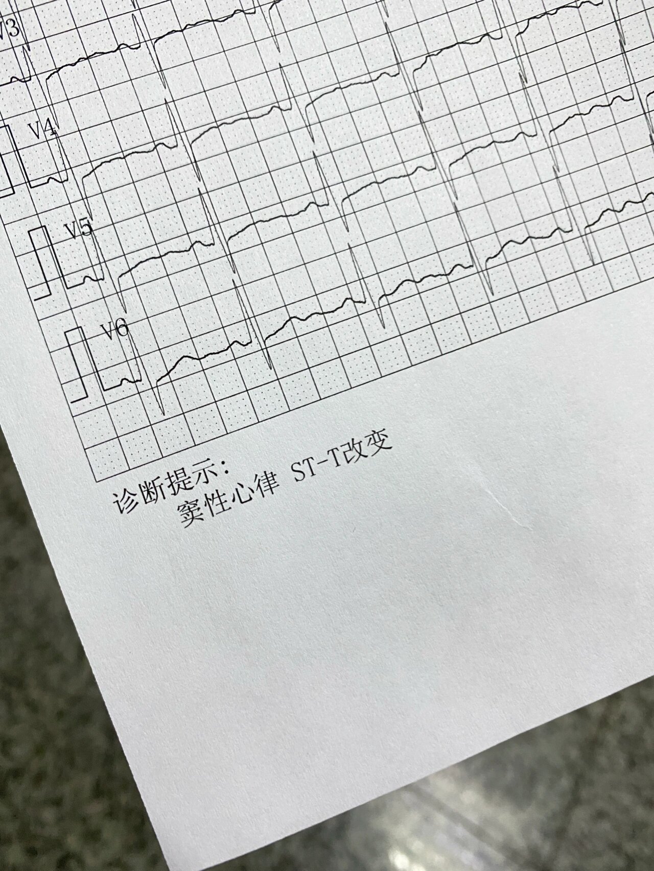 st-t改变心电图图片
