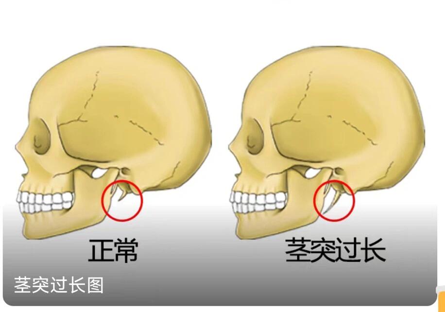 颈突的位置图片图片