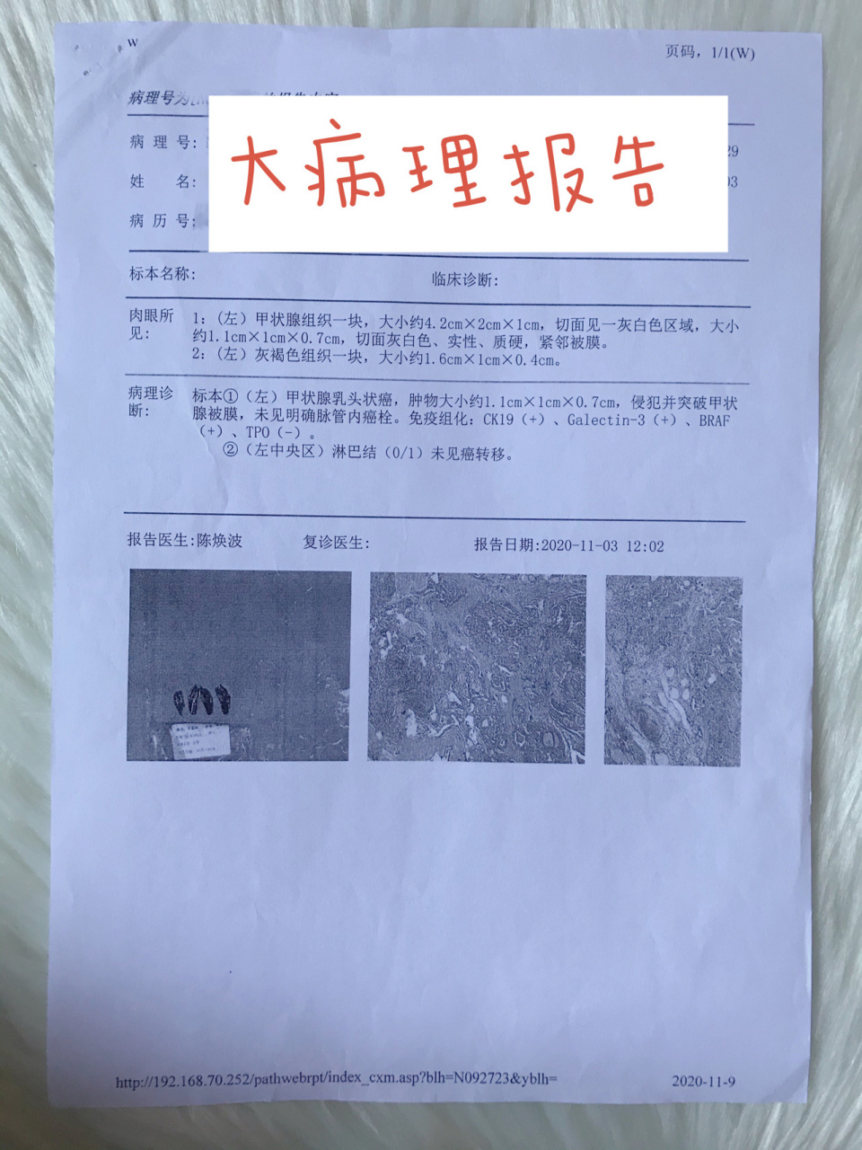 甲状腺癌半切术后大病理和甲功结果分享97 about 甲状腺癌左侧半切