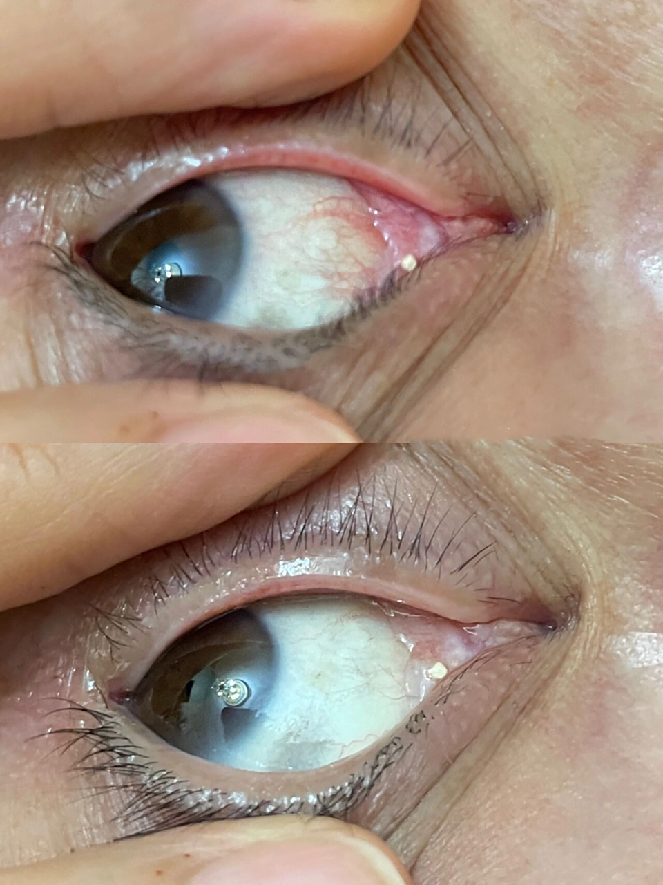 99眼睛长结石是指眼睛的结膜长结石,就是在上下眼皮内侧面,即睑