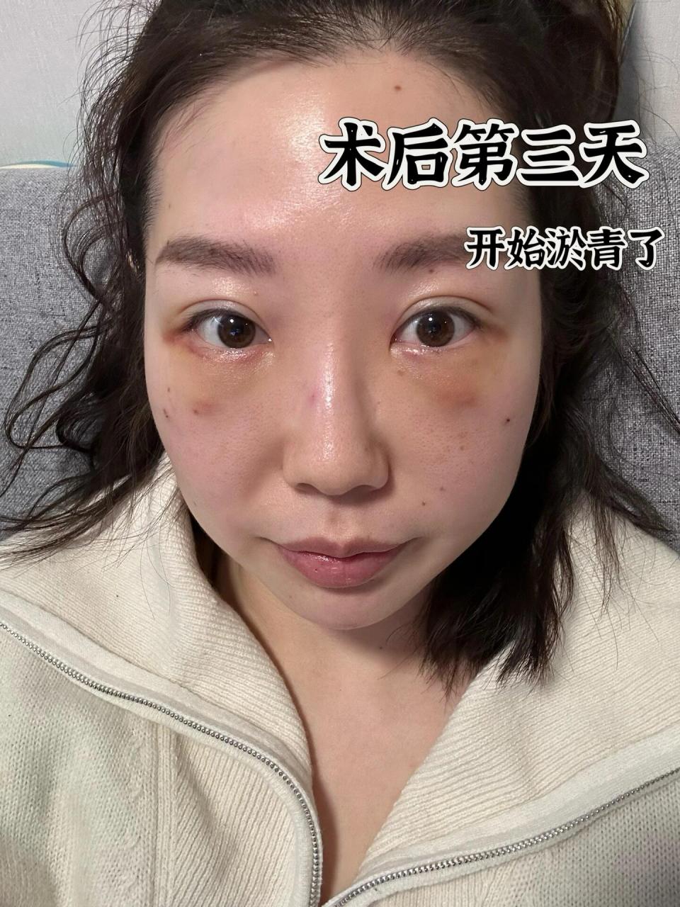 上海九院内切眼袋 纯分享 🔸之前在别的姐妹文章下面有评论过自己内