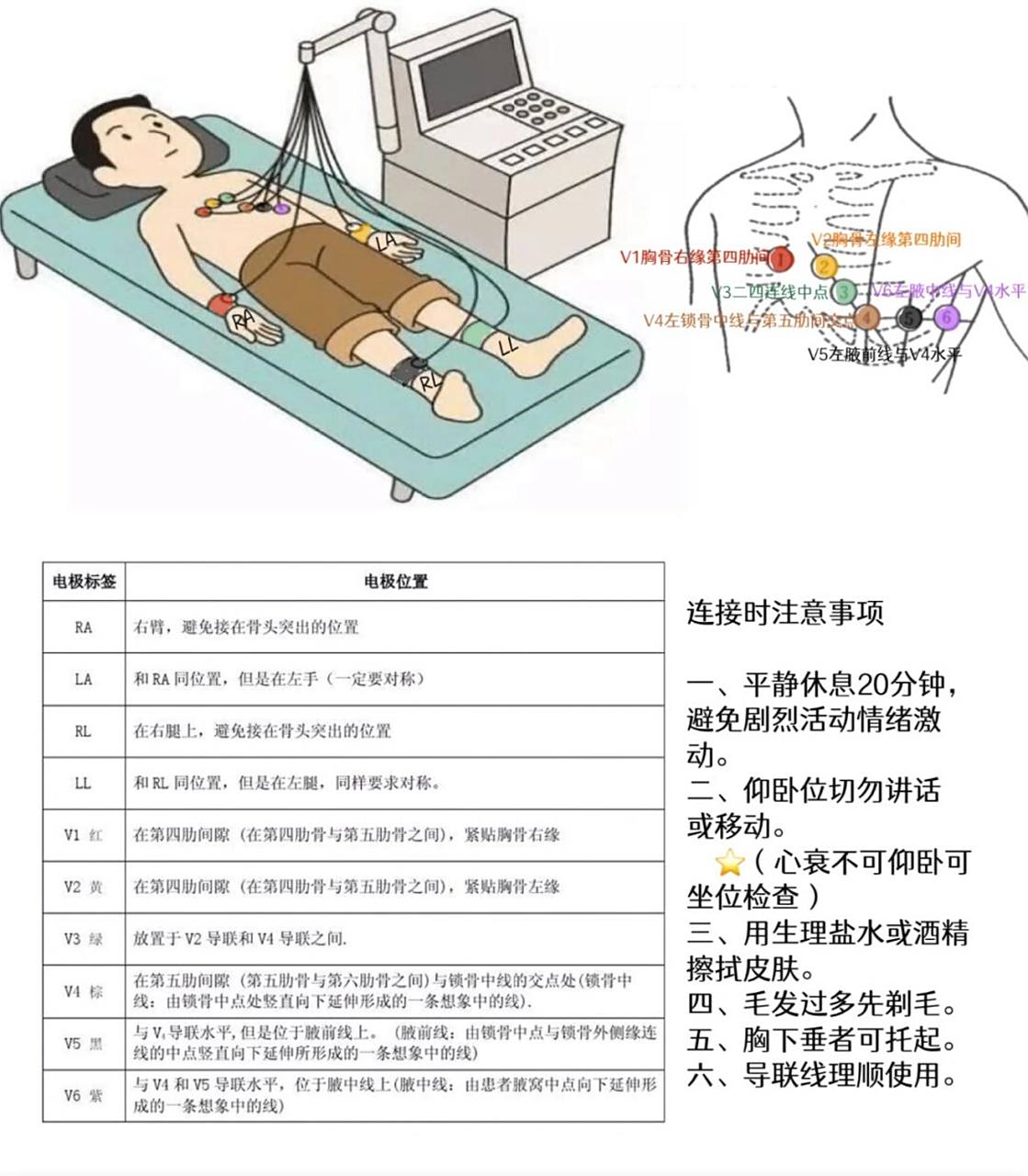 实习不尴尬/一张图学会连接十二导联 73肢体导联放置: 7815右