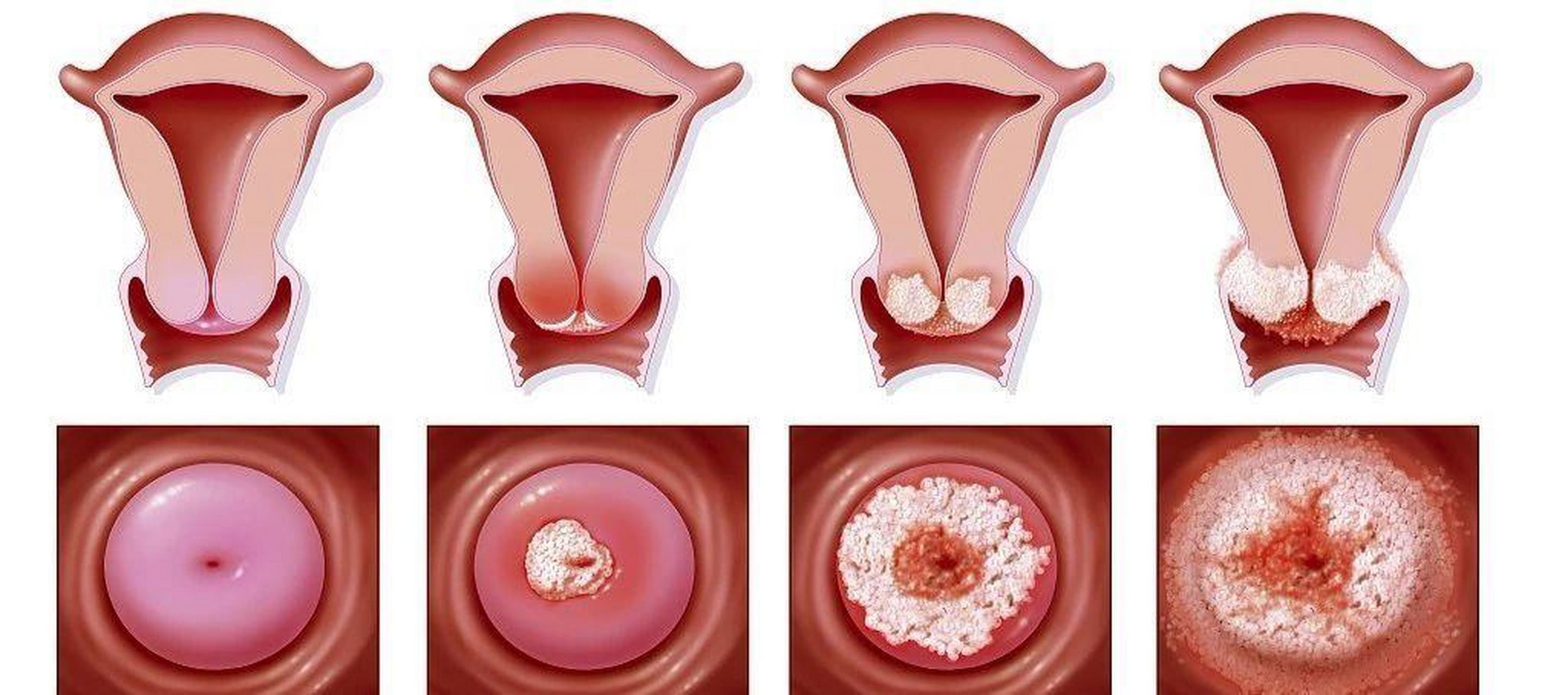 女性得了阴道炎盆腔炎,可以同房吗?