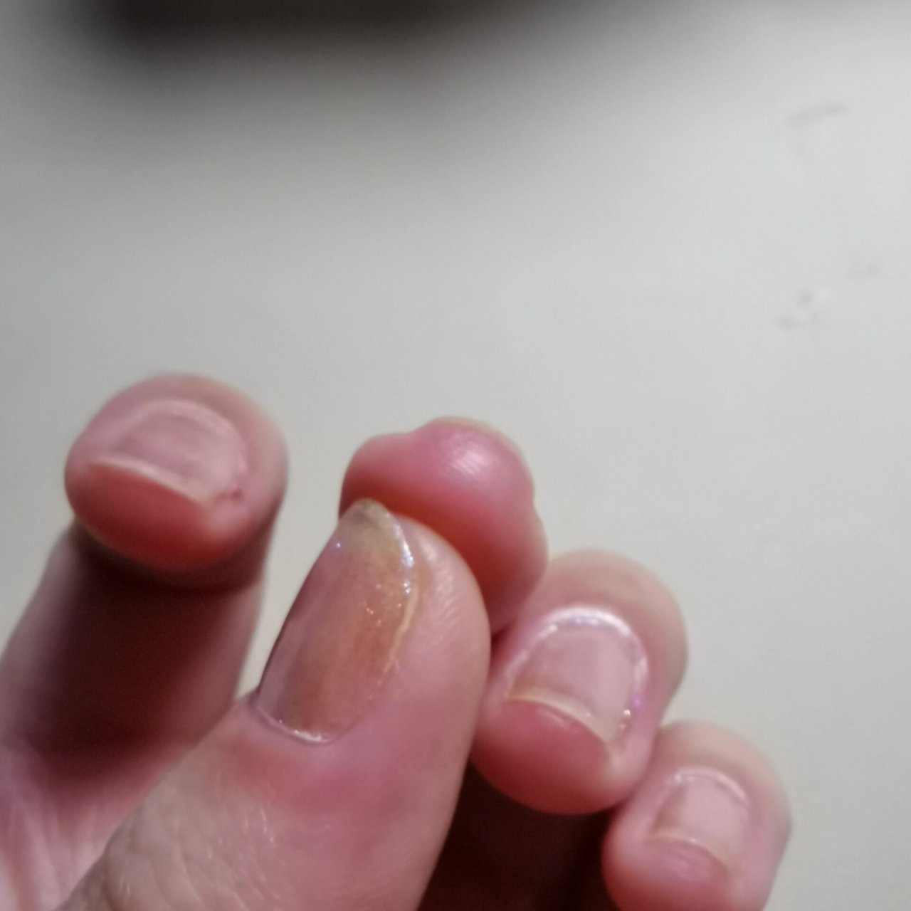 尖上有红点点 如图,手指尖上有红点点,有个手指尖上好像是湿疹一样的