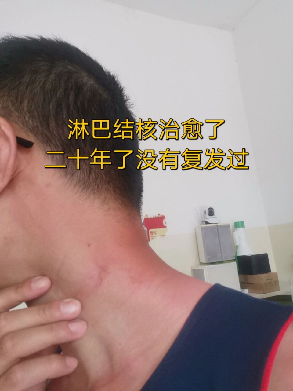 淋巴结核,淋巴结肿大,没破溃的,破溃的来