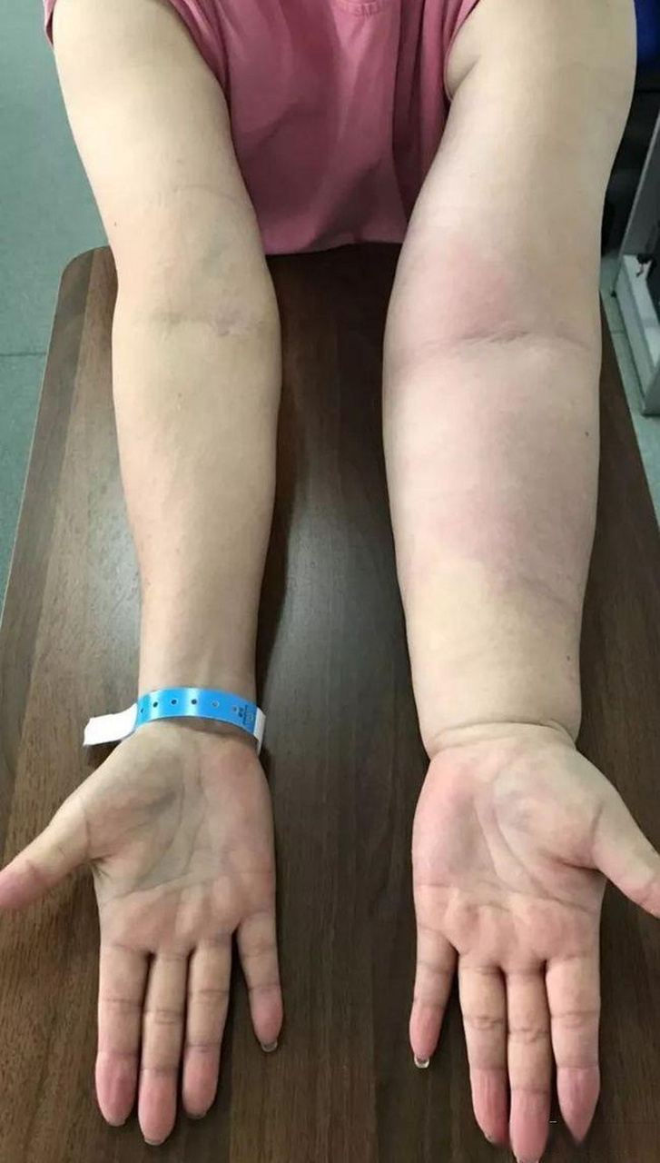 乳腺癌术后上肢淋巴水肿 乳腺癌淋巴清扫术后破坏了淋巴回流系统,导致