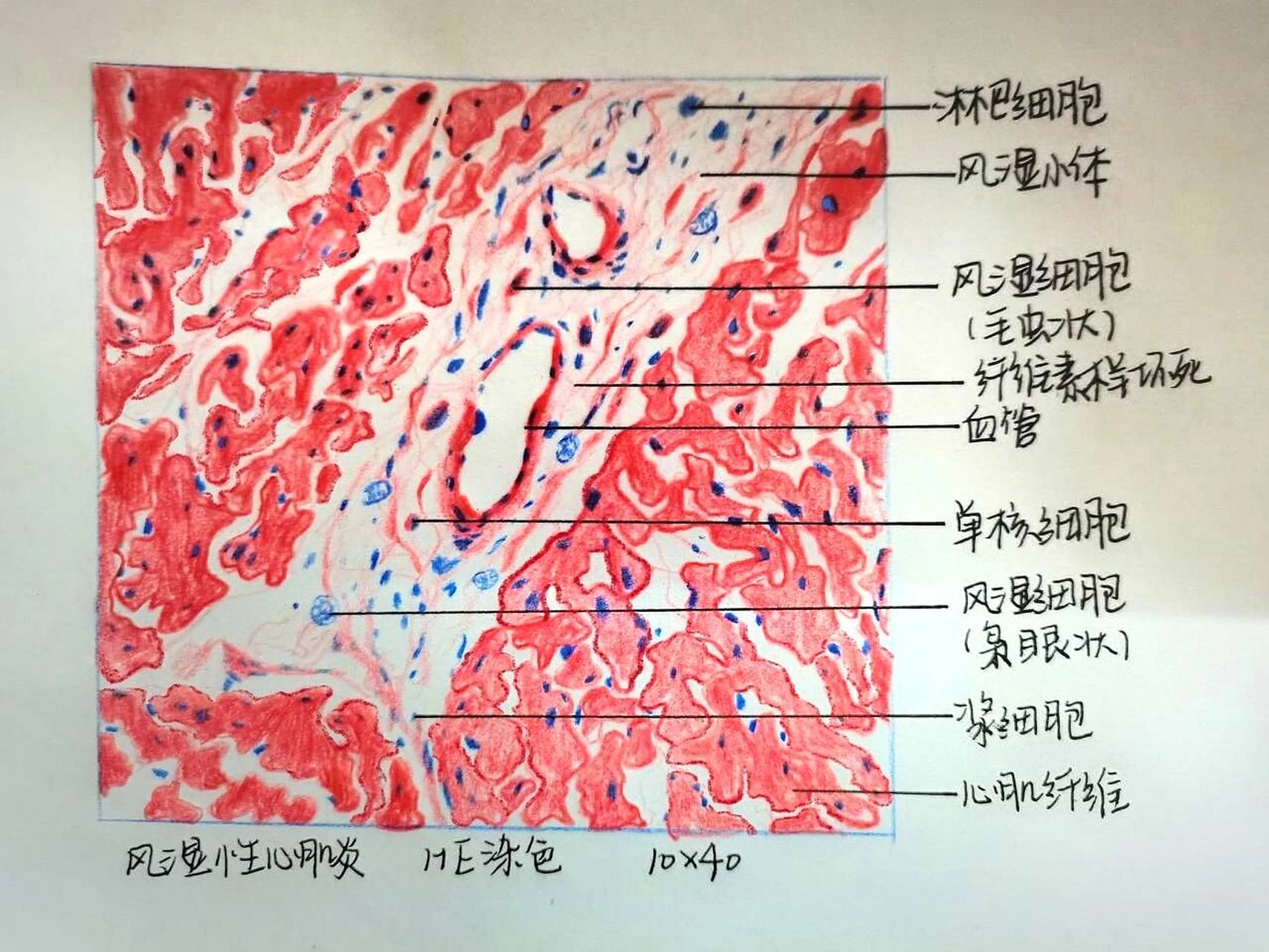 病理红蓝铅笔绘图:风湿性心肌炎 #医学生# #医学生笔记# #医学# #红蓝