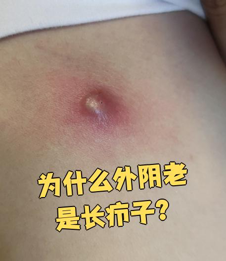 另外,如果外阴部位抵抗力较弱,细菌就容易入侵毛囊,导致疖子反复发作