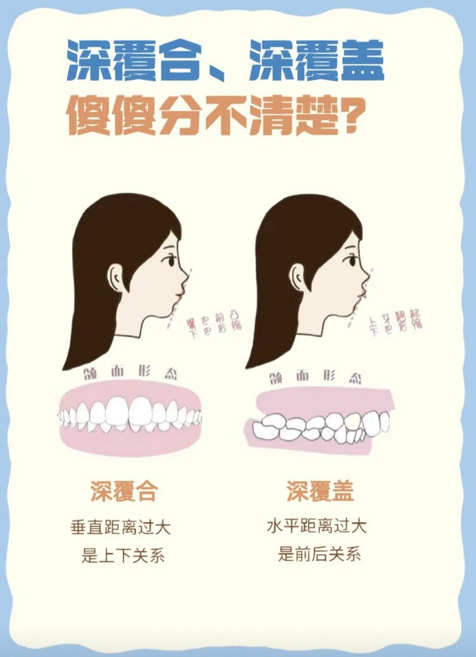 牙齿矫正助理带你看懂深覆合深覆盖的区别 什么是深覆合 前牙覆合是指