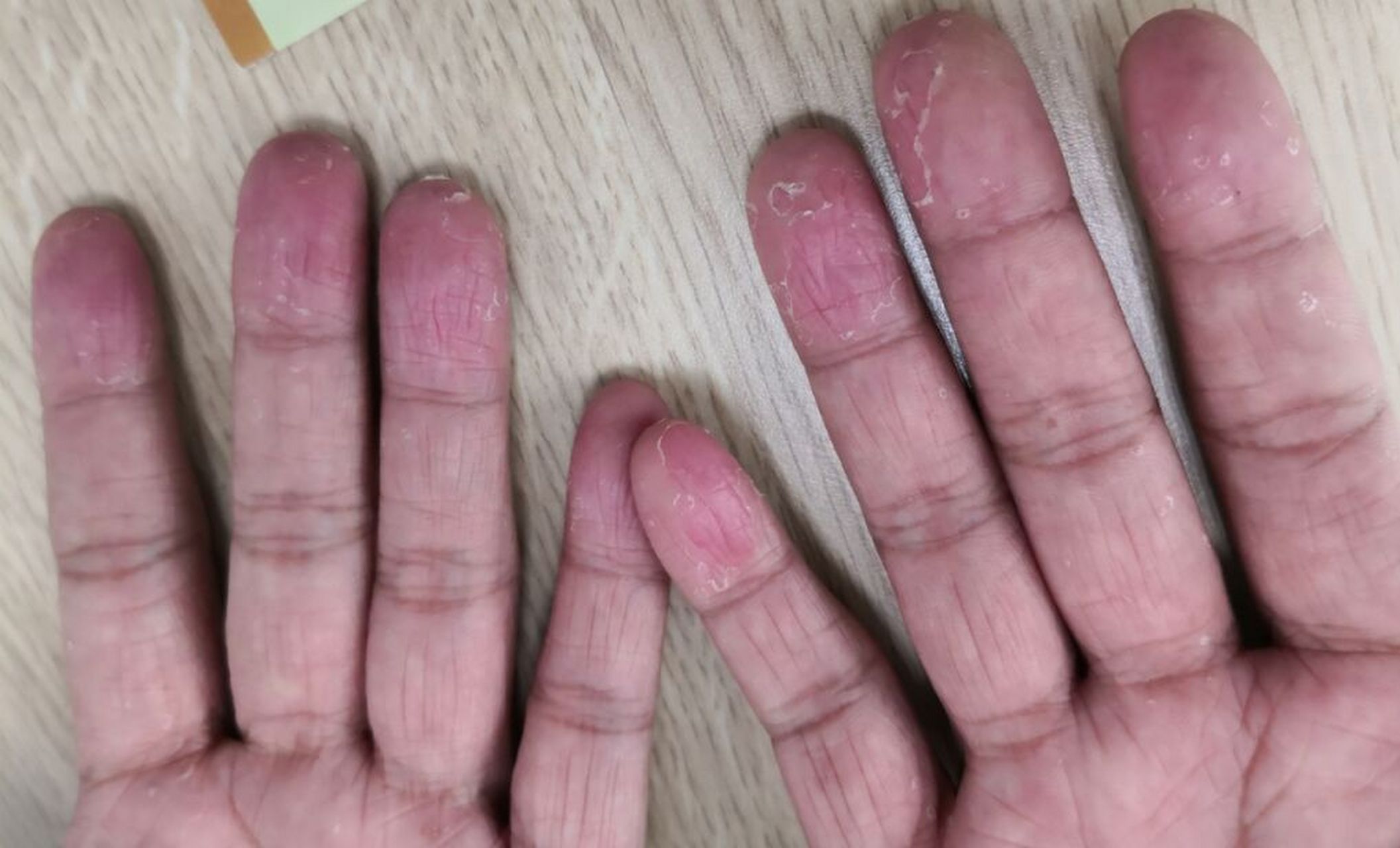 手指总脱皮? 缺维生素or皮肤病?