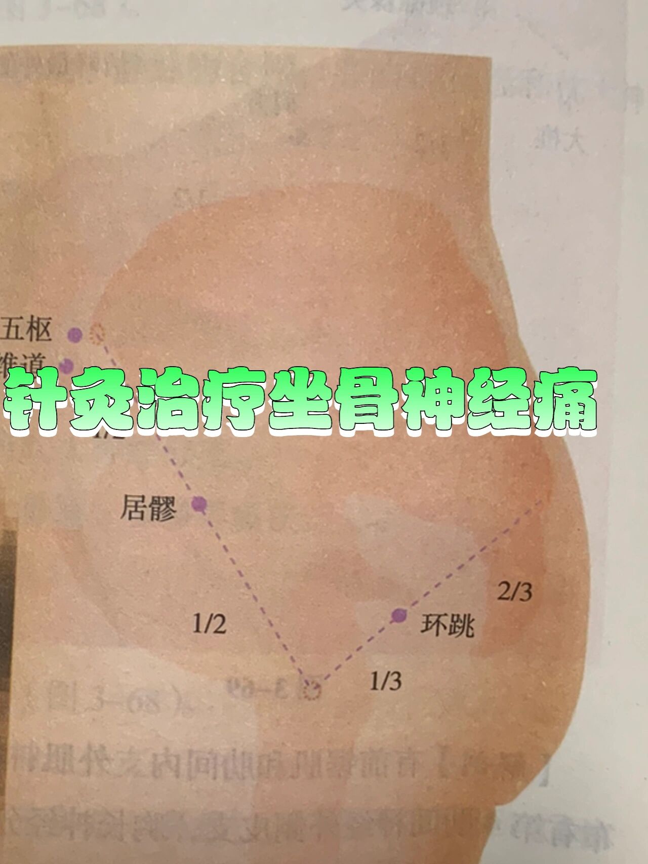 针灸治疗坐骨神经痛〖医案篇〗 万方琴教授曾在《万一针》中记录一