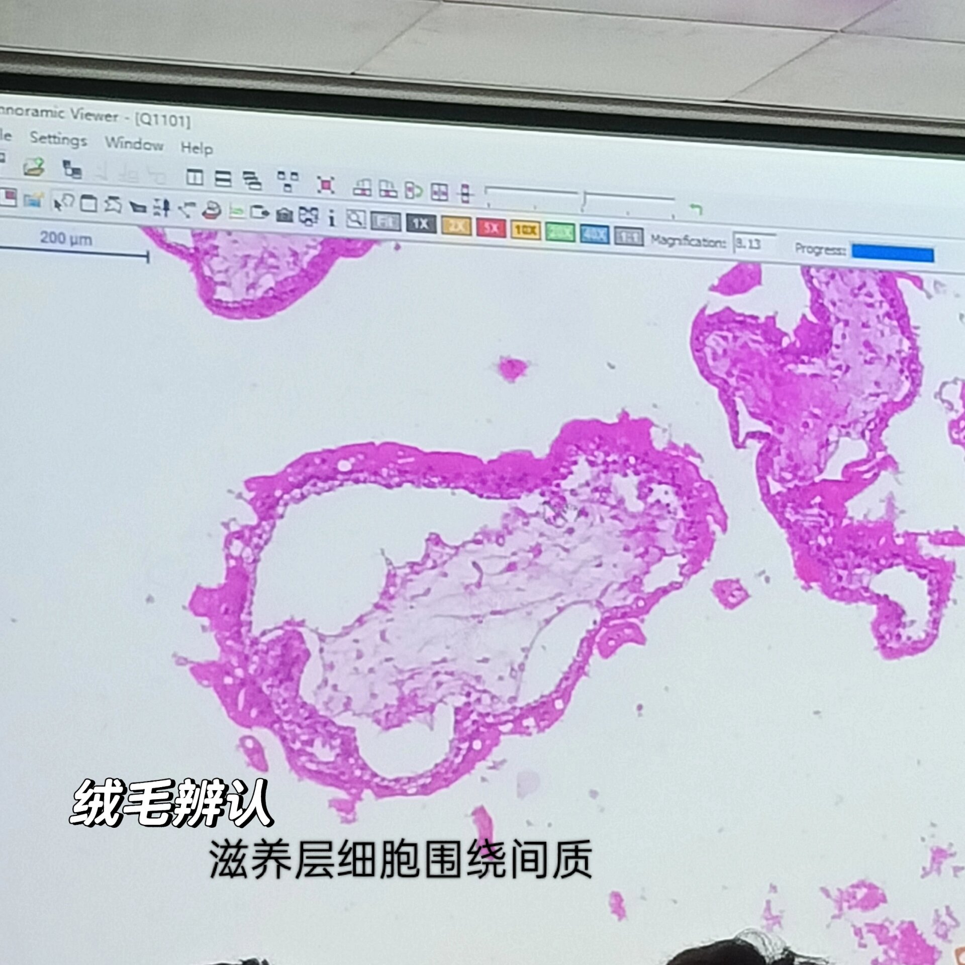 【病理切片复习】葡萄胎(自用)