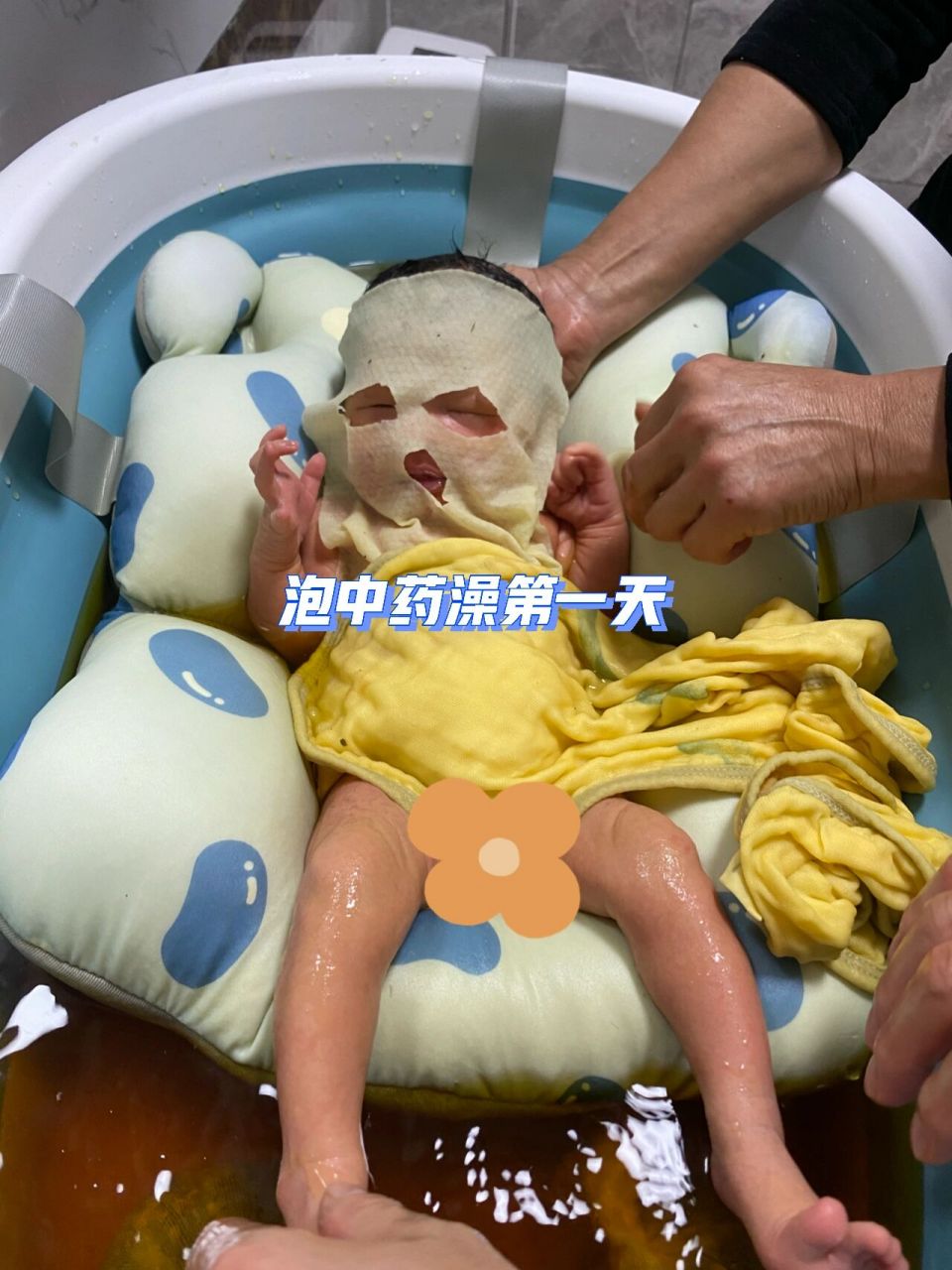 泡中药浴给宝宝退黄疸 7915宝宝出生第七天黄疸值还是高,平均值13