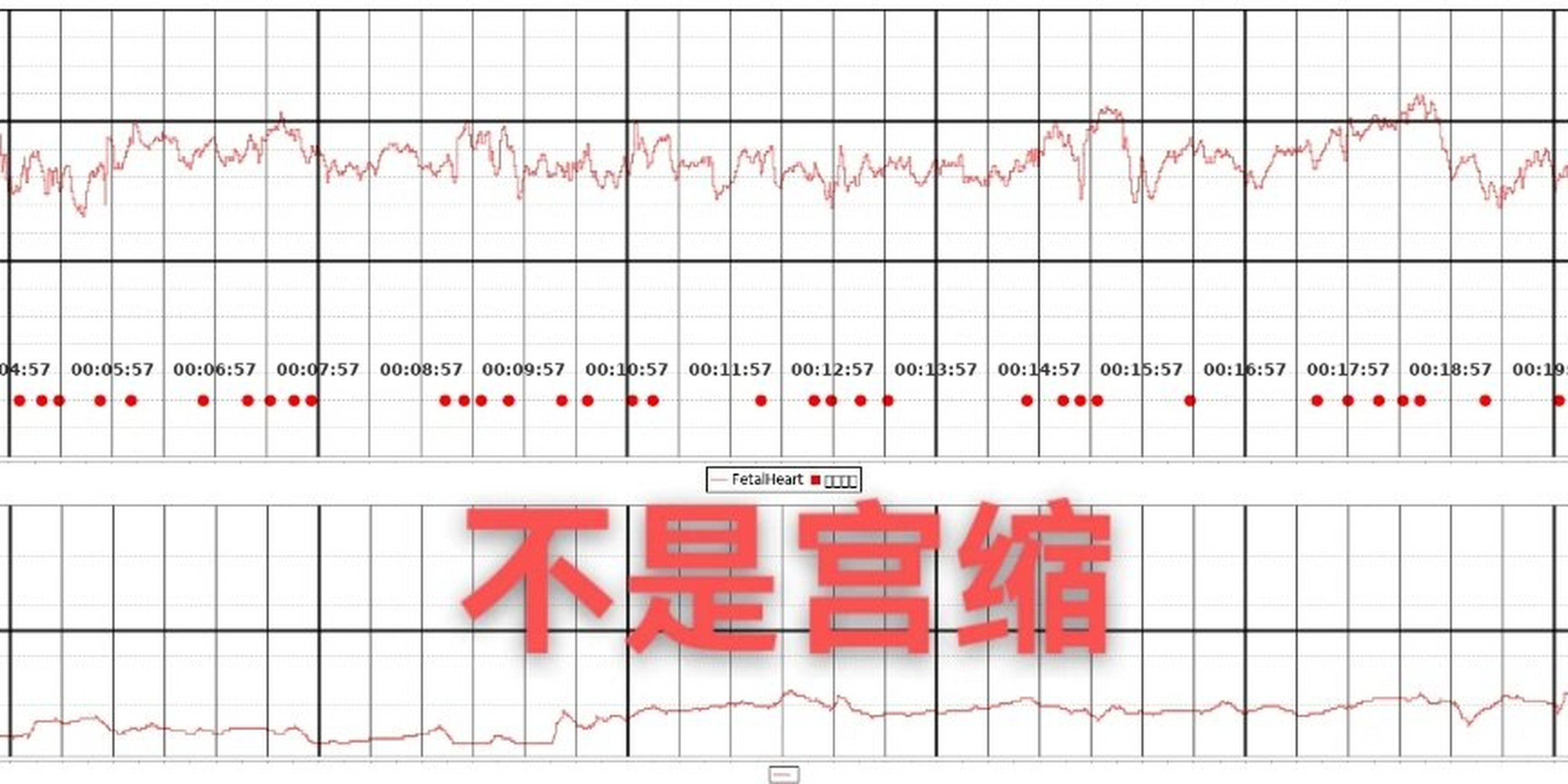 宫缩图怎么看图片