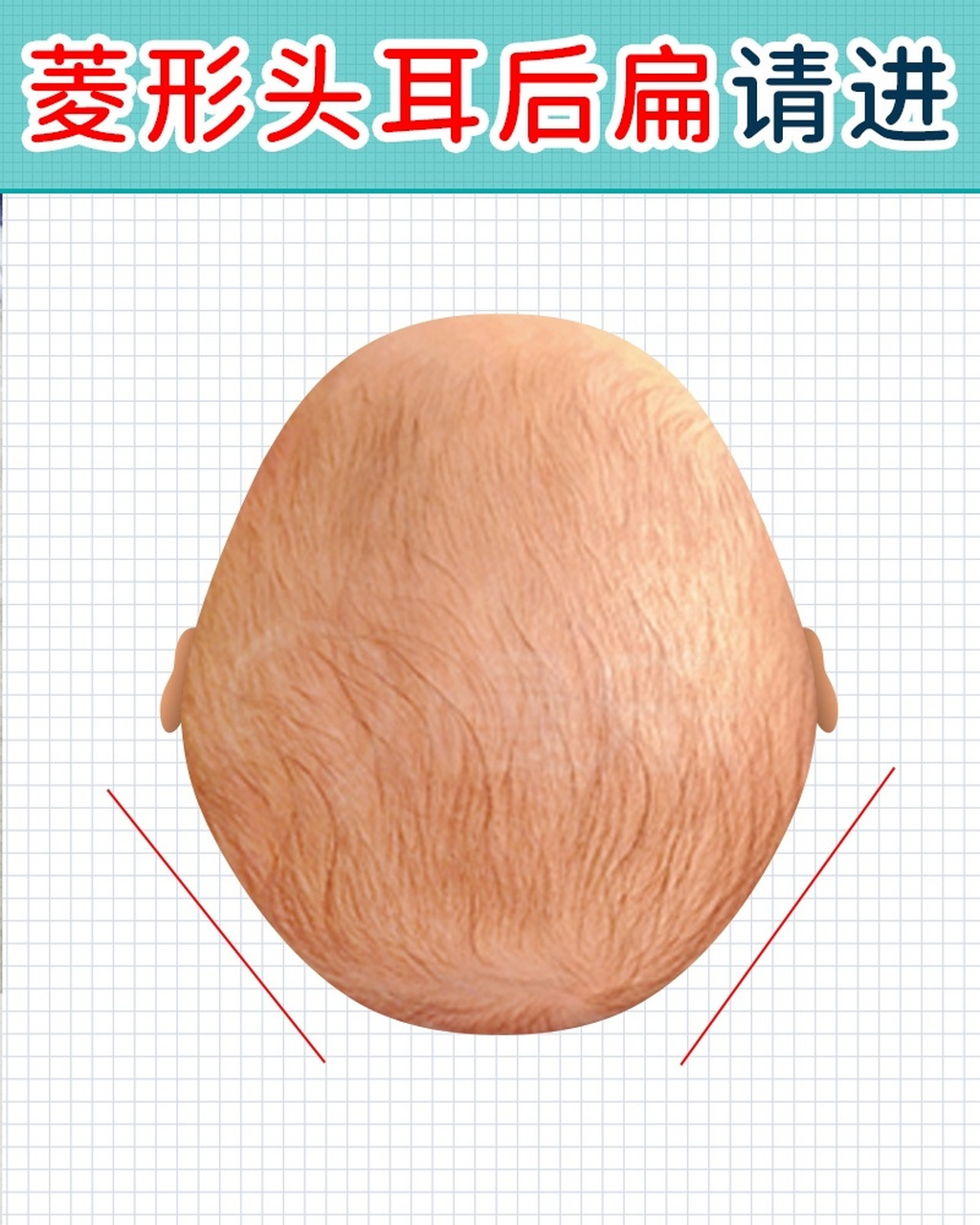 头睡出菱形头/耳后扁如何调整 97还在为菱形头/耳后扁着急吗?