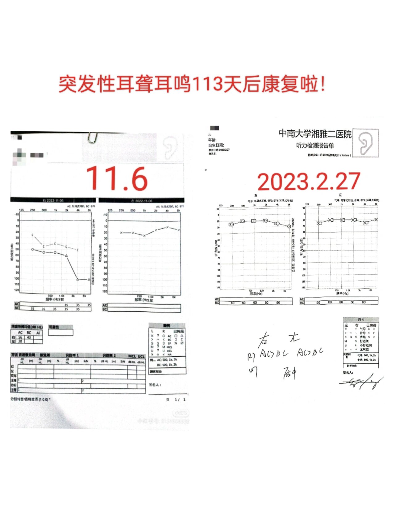 突发性耳聋耳鸣113天后康复 始于2022年11月6日,终于2023年2月27日.