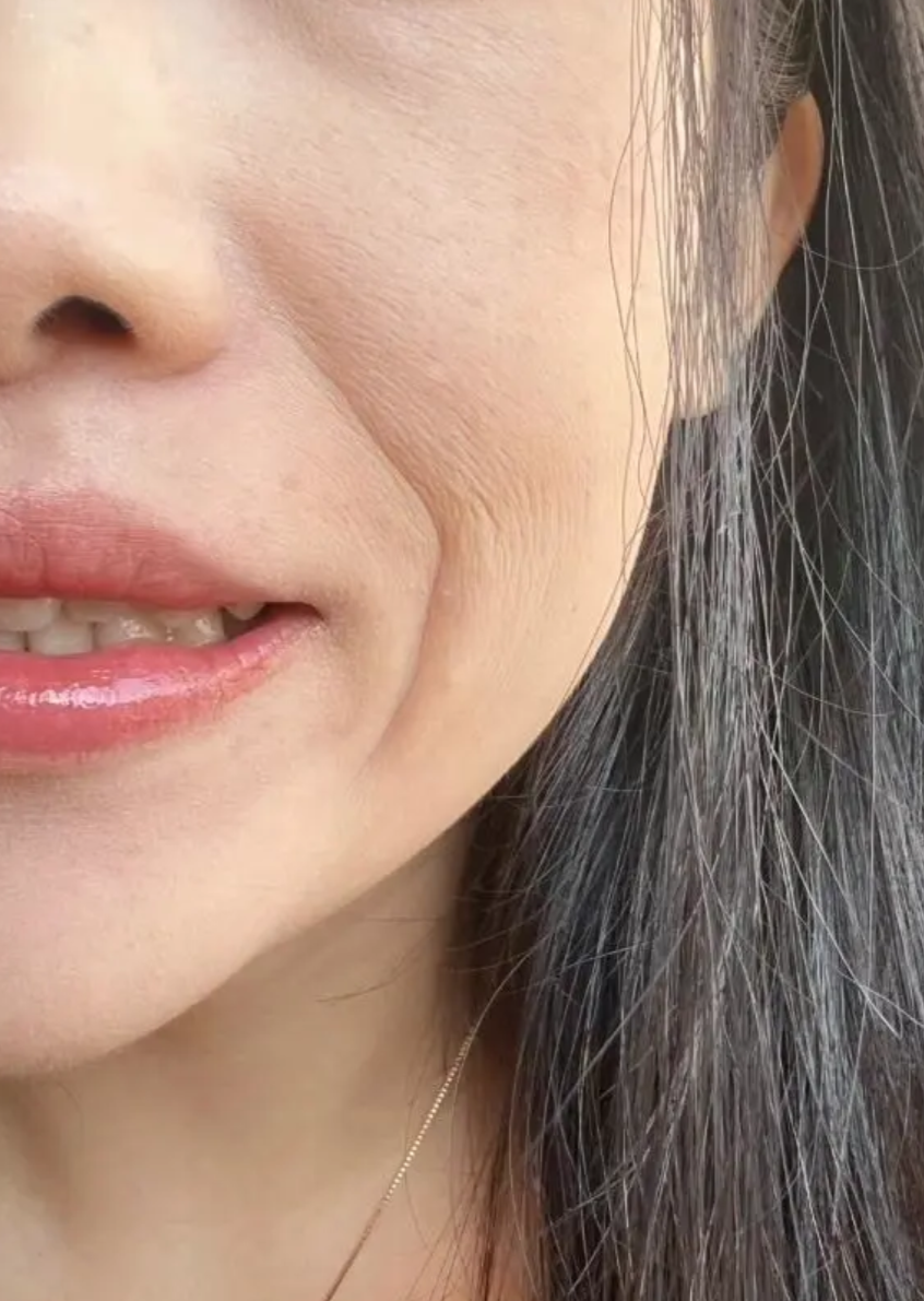 经常笑确实可能导致法令纹,但这不是主要原因