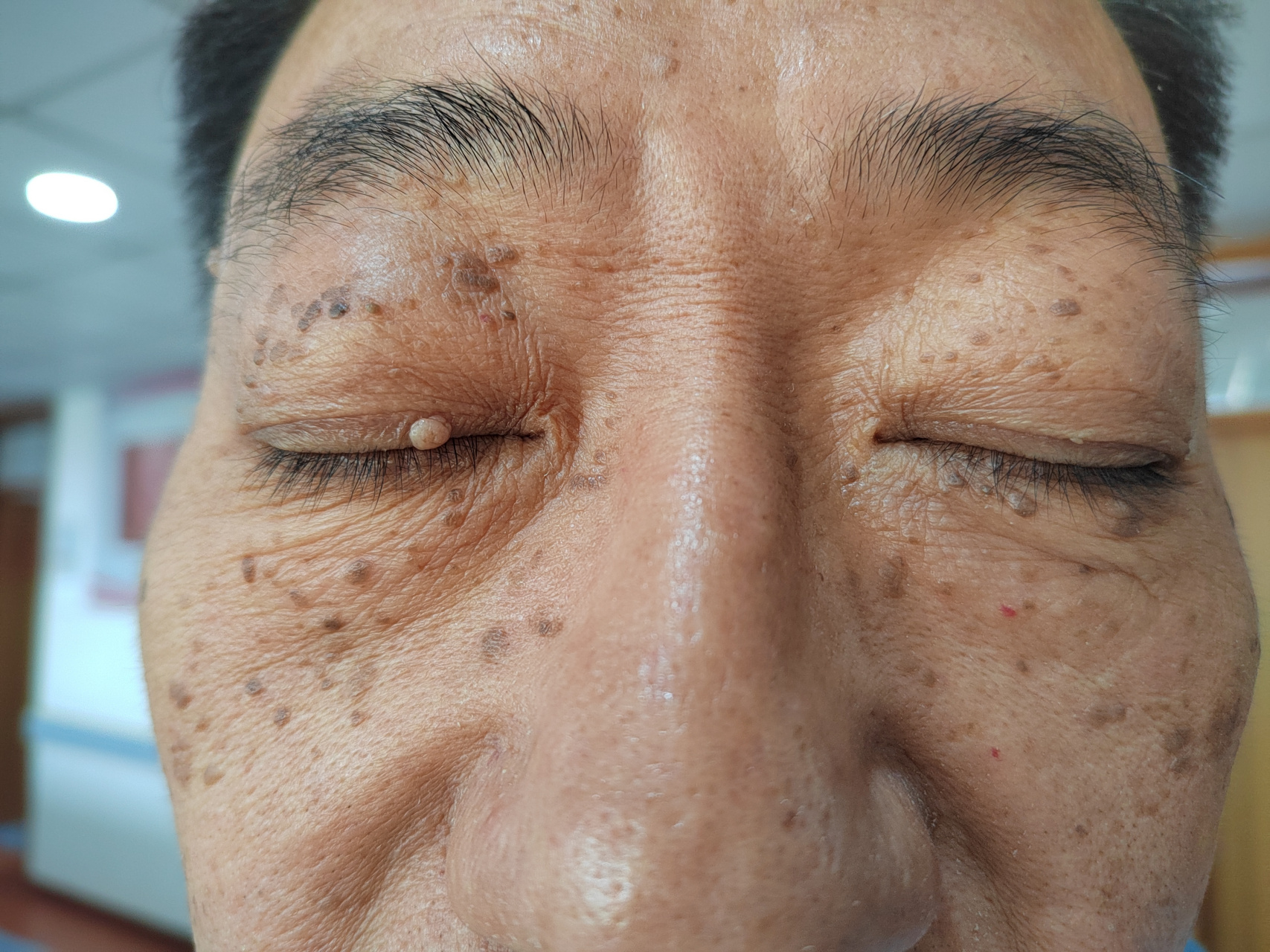 激光美容##老年斑