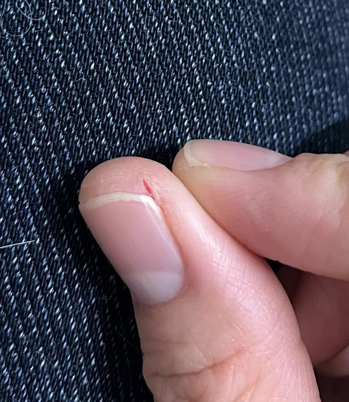 一到冬天手这里就裂开 这两年每到冬天天一冷就这样,就拇指指甲旁边裂