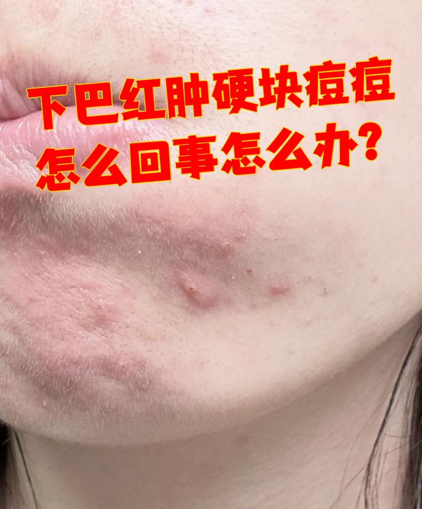 下巴红肿硬块痘痘怎么回事怎么办?