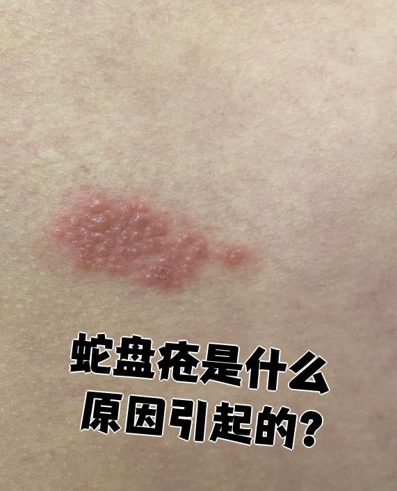 带状疱疹(俗称蛇盘疮)是水痘