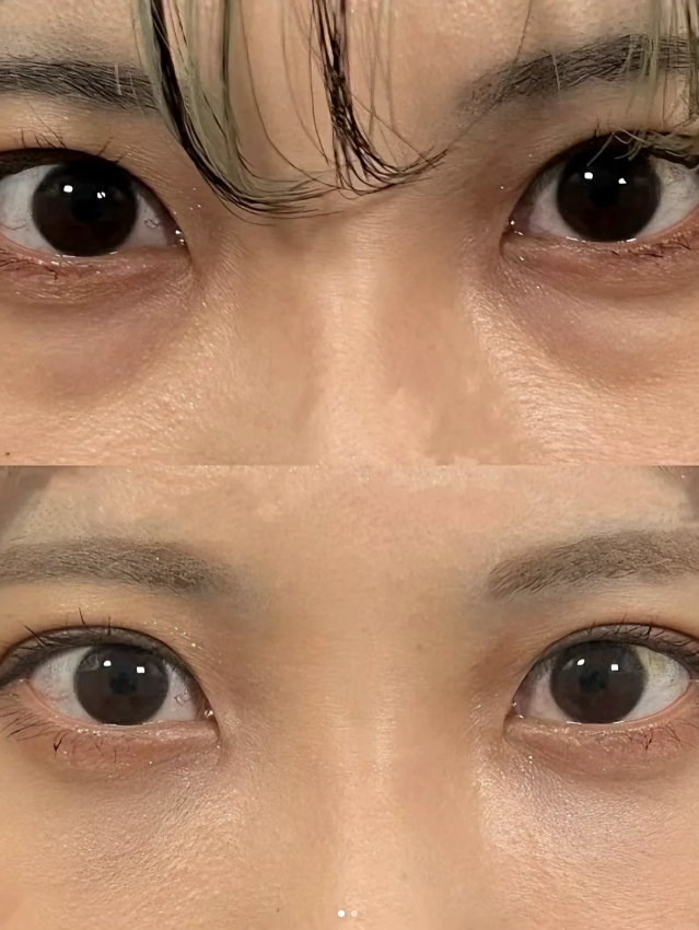 怎么没人替内切眼袋发声啊!