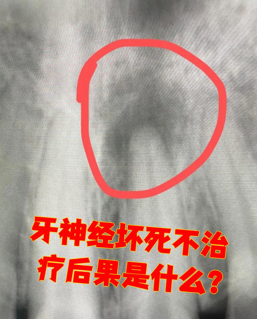 牙神经坏死如果不治疗,可能会引起根尖周炎和根尖囊肿等问题