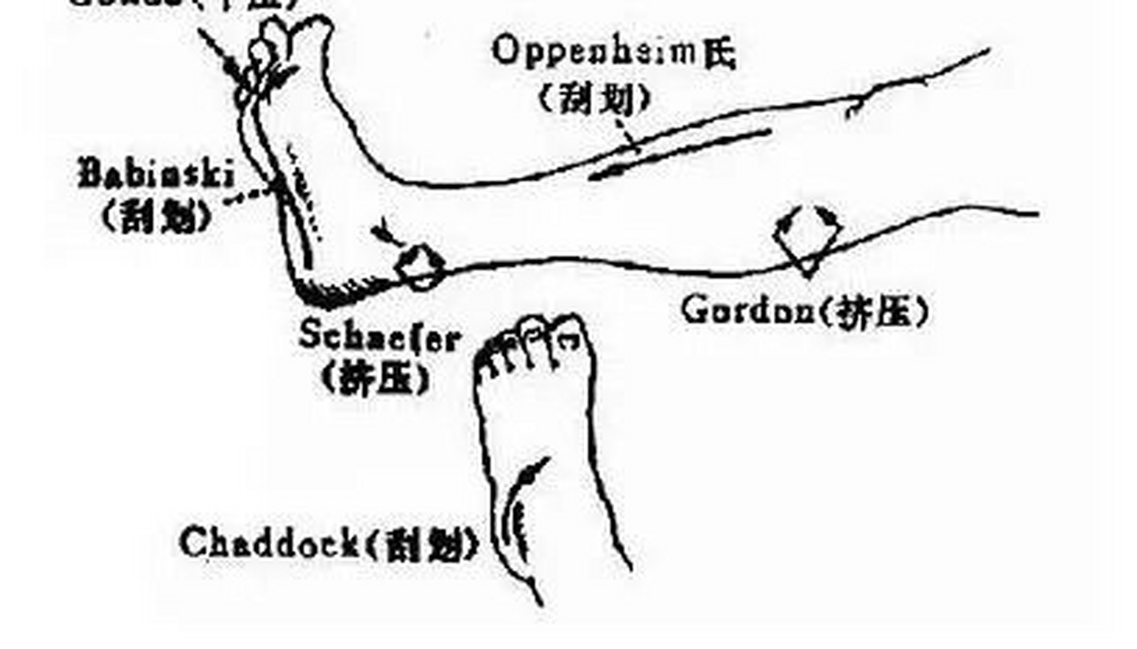 babinski征阳性: 见于上运动神经元损伤,是区分上,下运动神经元损伤的