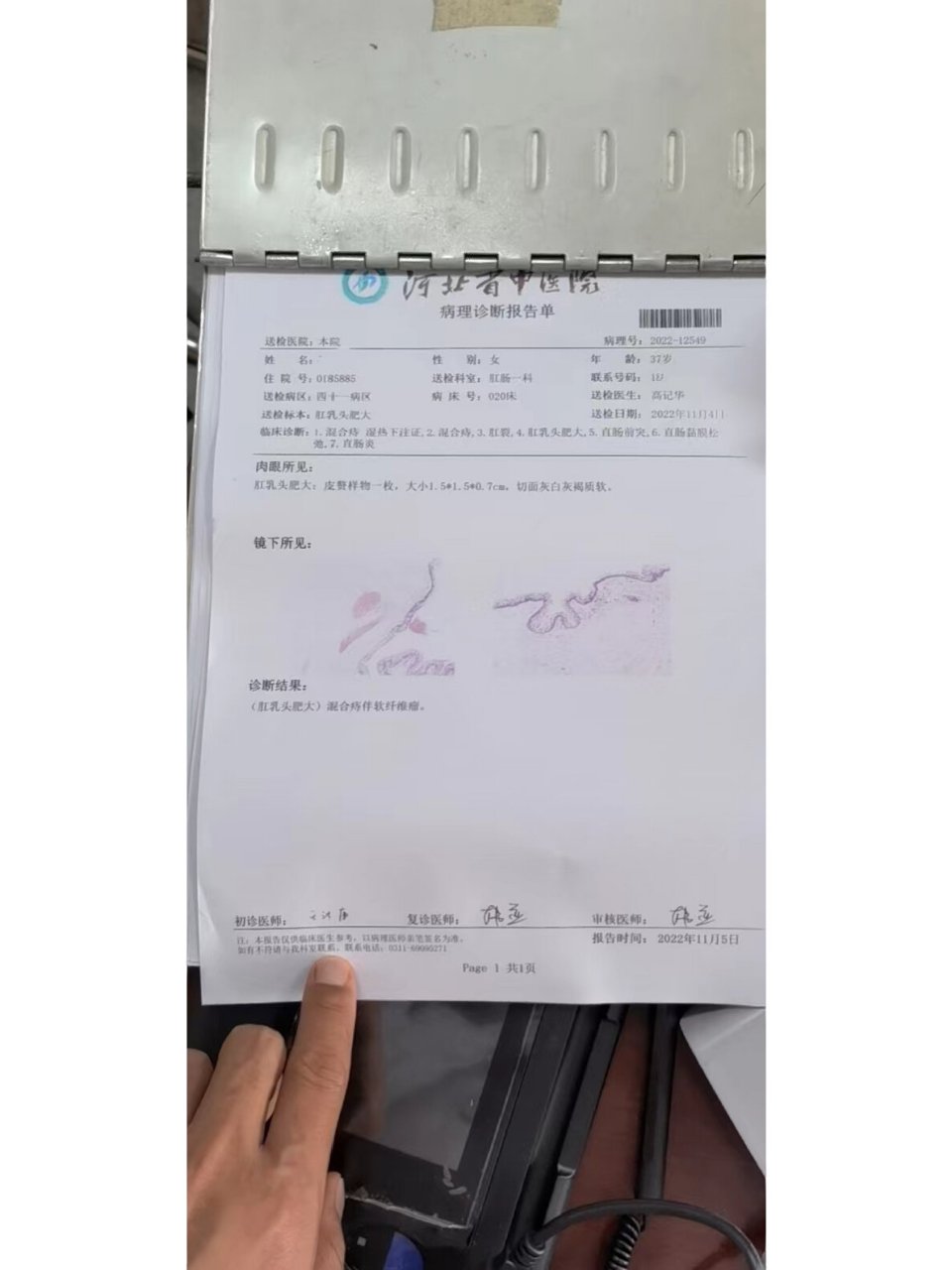 10年痔疮 终做手术!