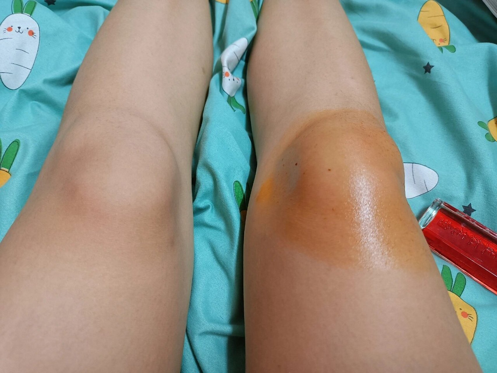 髌上滑囊炎 2018年夏天被车刮了摔到右腿膝盖 当时拍了ct医生说没什么