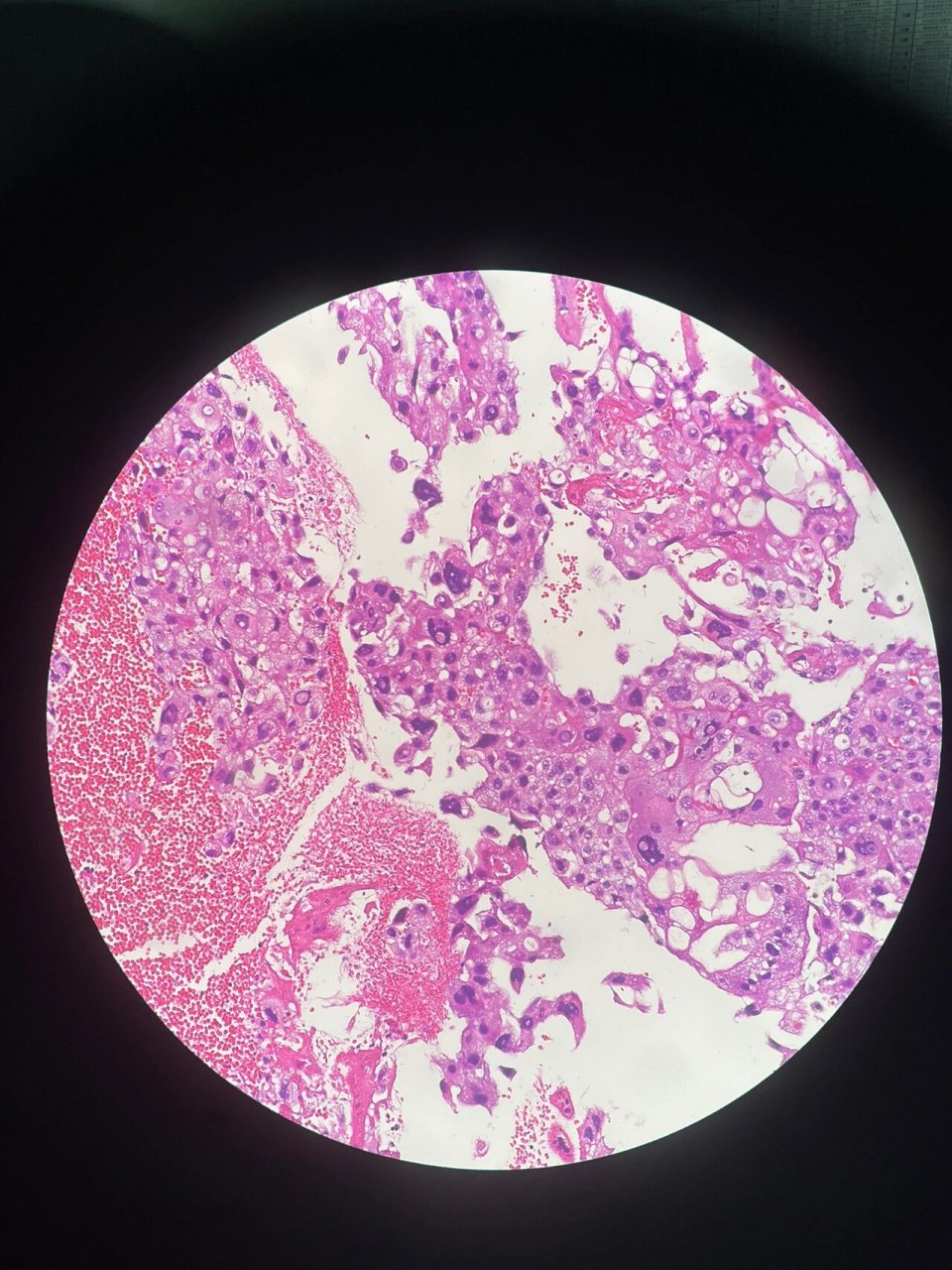 葡萄胎 1-3不完全性葡萄胎 4,5完全性葡萄胎 6正常绒毛