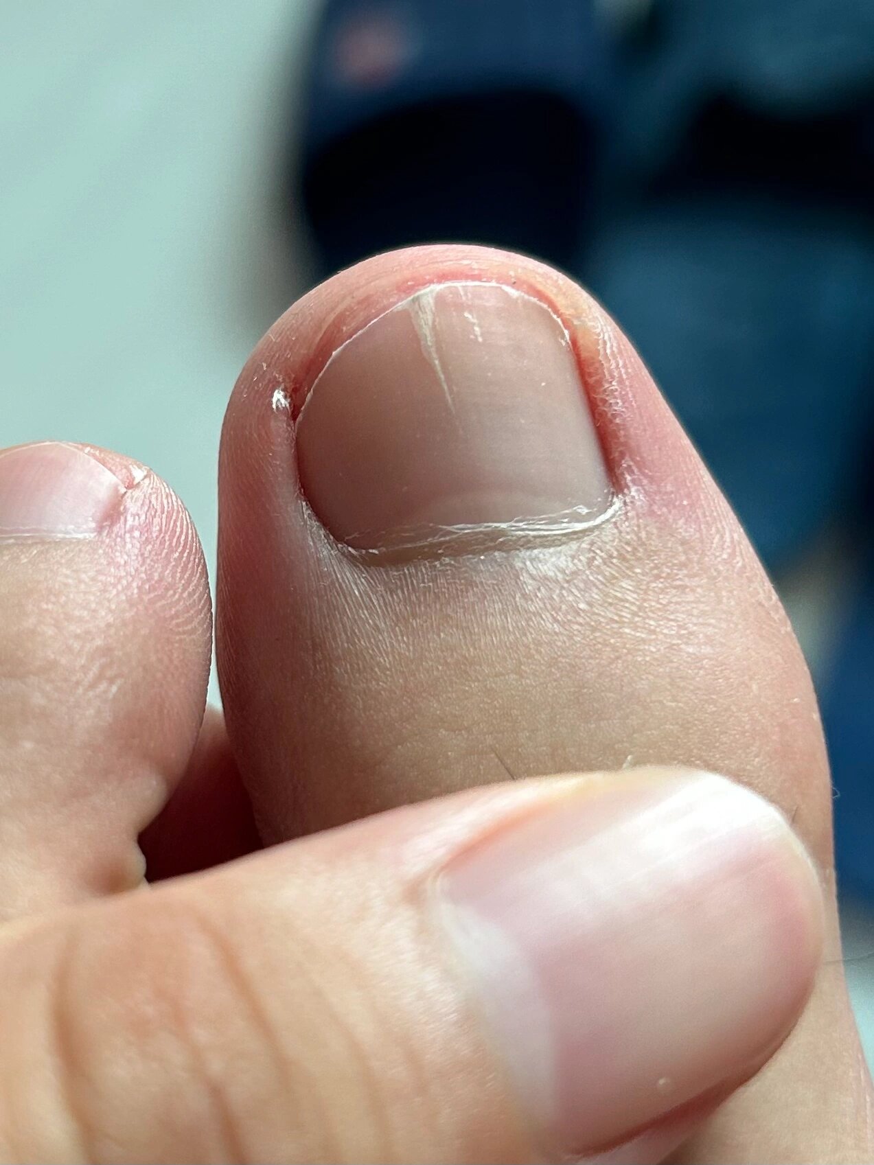 为啥脚趾甲中间裂开了啊