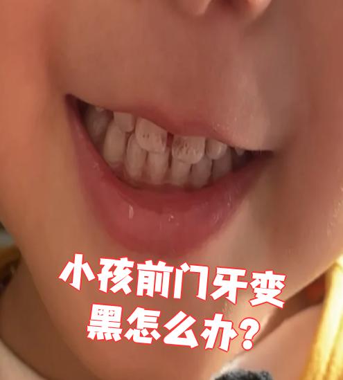 这种情况只要好好刷牙,每天早晚用儿童牙膏清洁牙齿就行