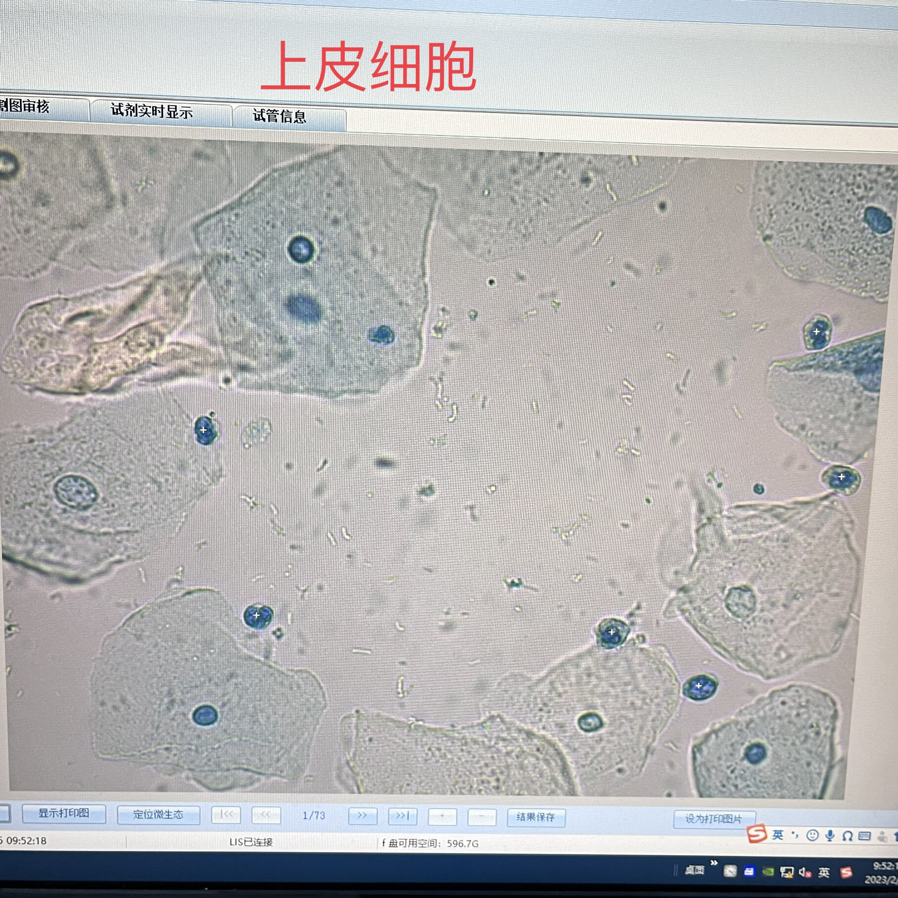 阴道分泌物镜检×1000  分泌物性状理学检测指标:正常为白色稀糊状,无