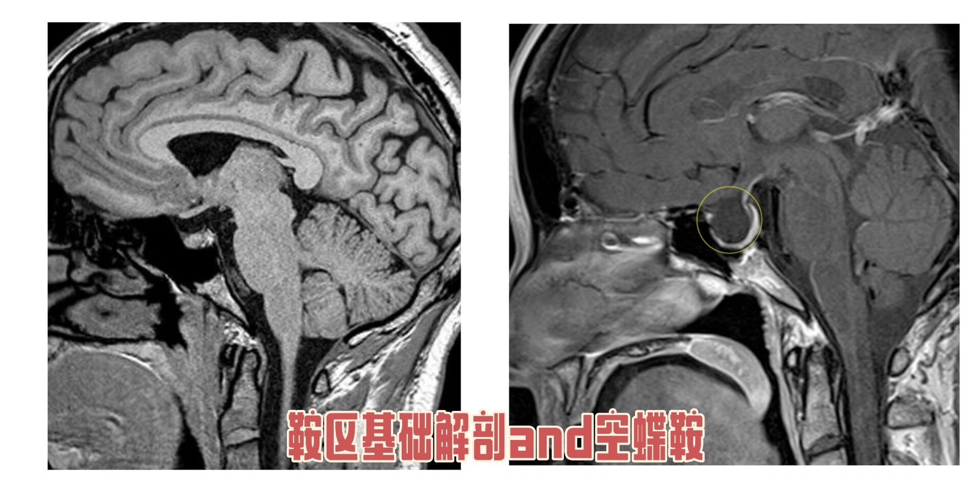 鞍区磁共振图片