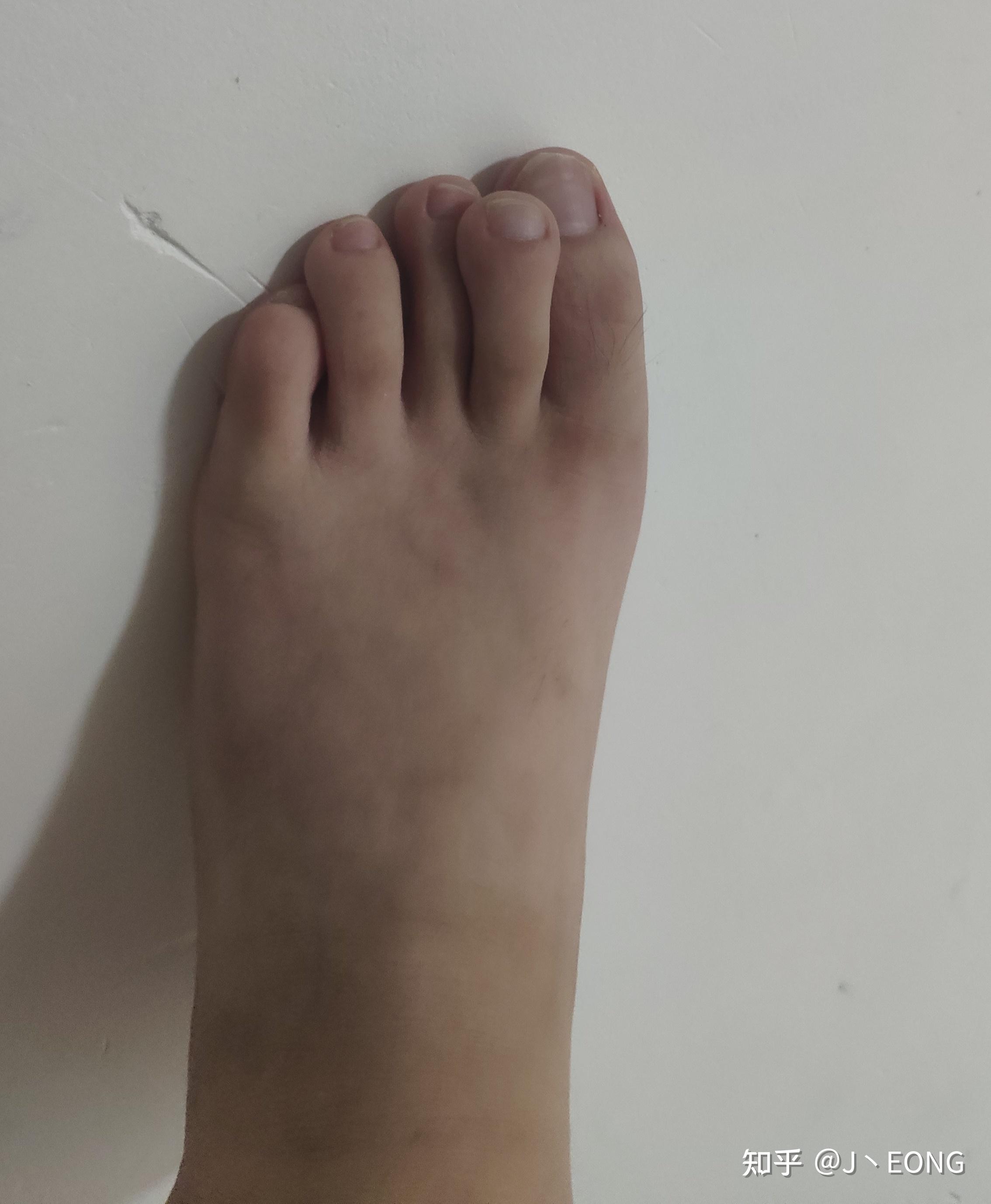 我的第二根脚趾头压在大脚趾头和二脚趾头上面有没有和我一样的朋友啊