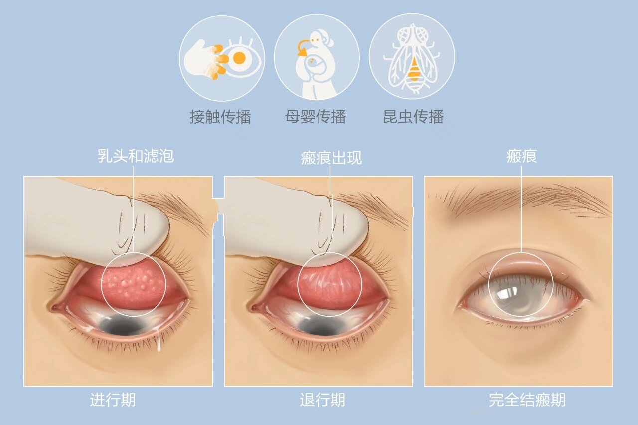 沙眼 沙眼(trachoma)是由沙眼衣原体感染所致的一种慢性传染性结膜角