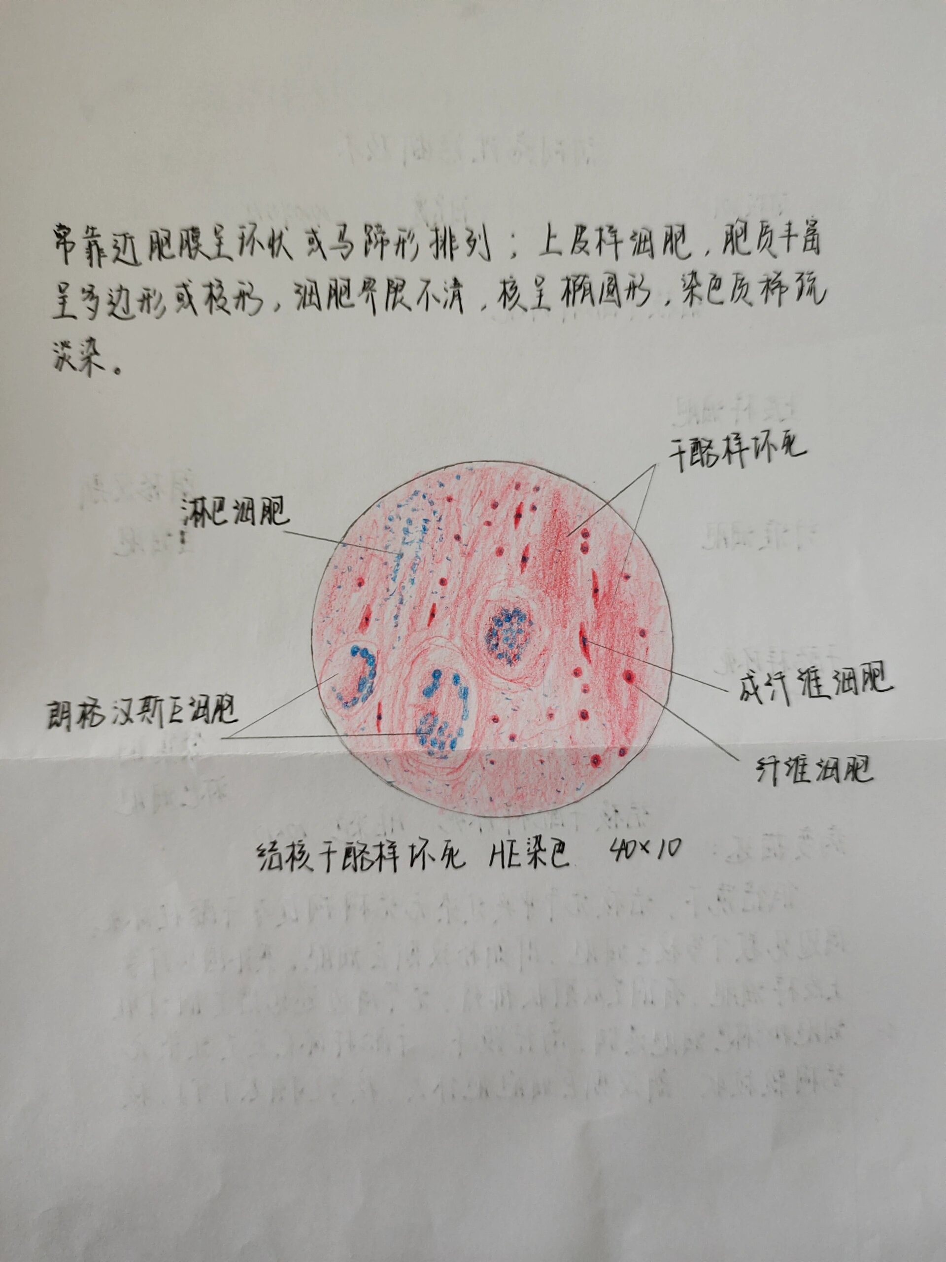 凝固性坏死图片干酪图片