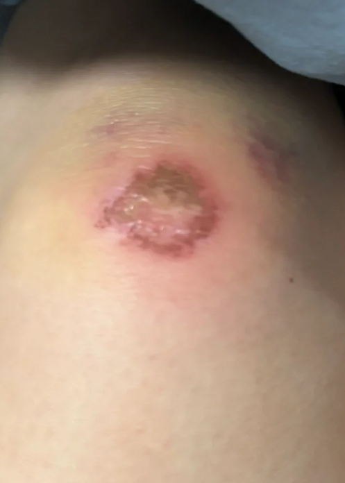 伤口破伤风的表现主要有伤口红肿,流脓,触痛和肌肉酸痛等症状