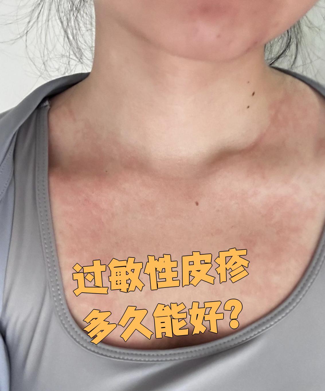 过敏性皮疹多久能好主要看病情严重程度和治疗方式