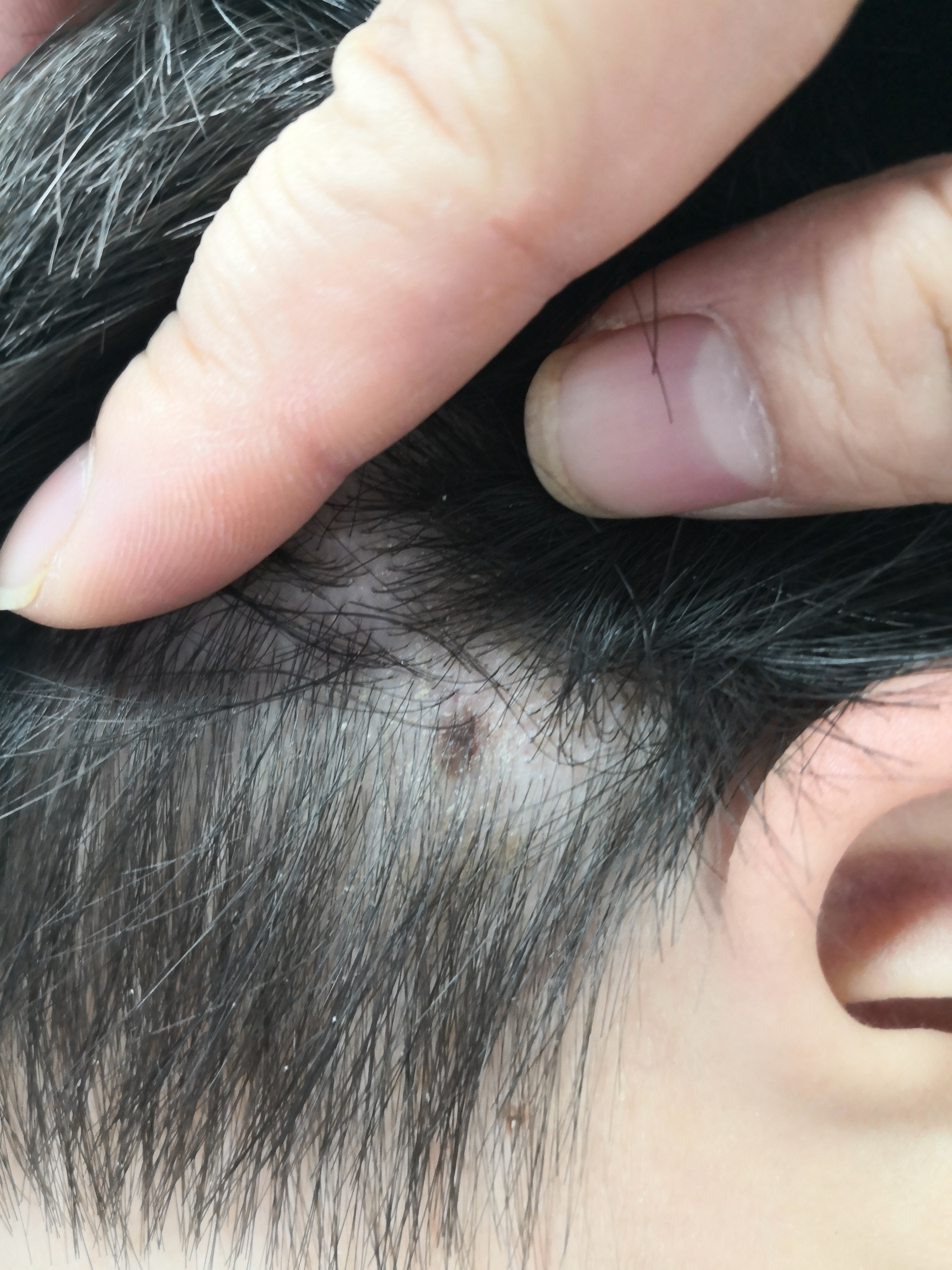 前胸头皮色素痣症状.可以手术切除活检诊断一下