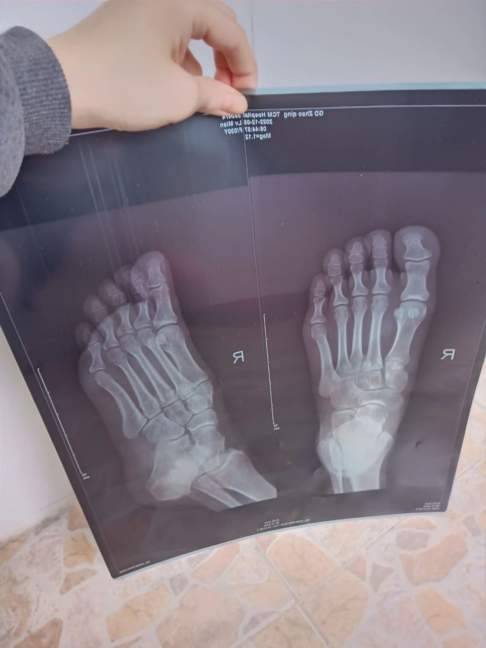 右足骨折图一第一次拍片图二三是第二次复诊 x光拍片不会看,有的骨又