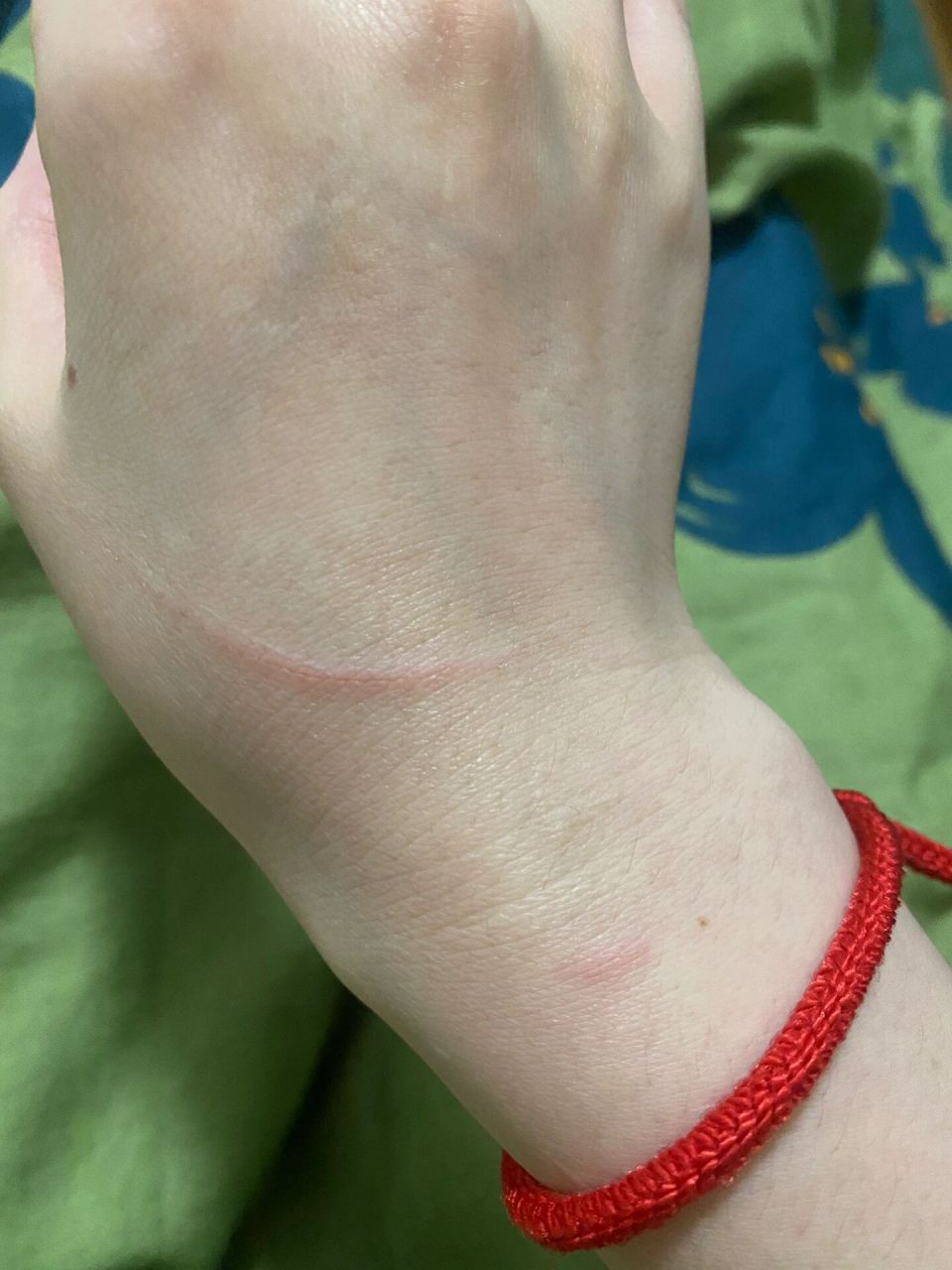 昨晚被家中2个多月的幼猫抓破皮了,刚接回来还没有打疫苗驱虫,需要打